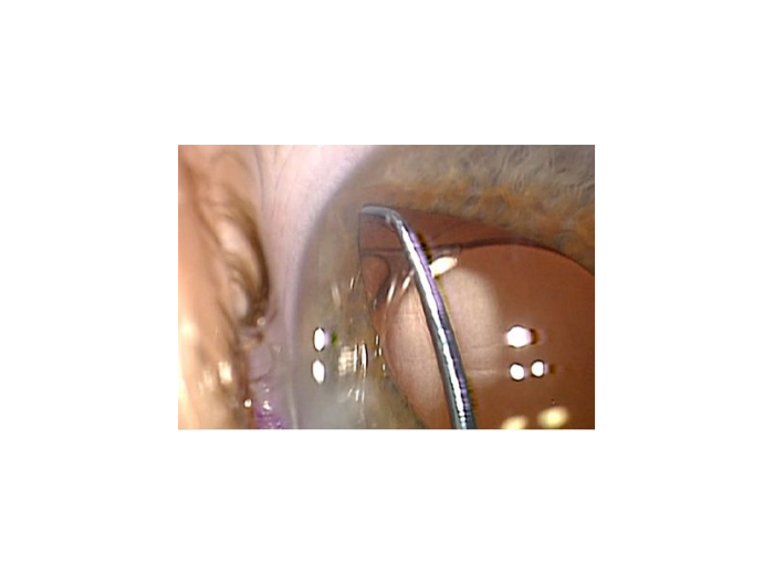 Devgan Universal Cataract Chopper/Multi-Tool