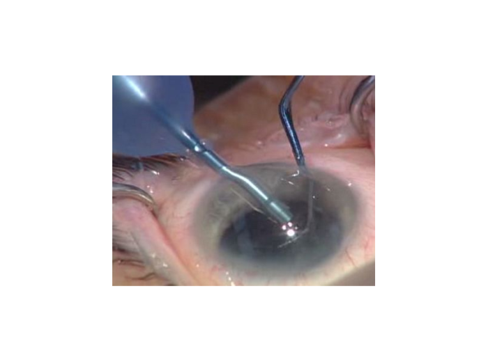 Devgan Universal Cataract Chopper/Multi-Tool